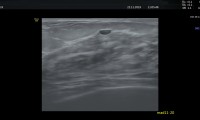 Pat 60a, gutartige kleine Cyste
